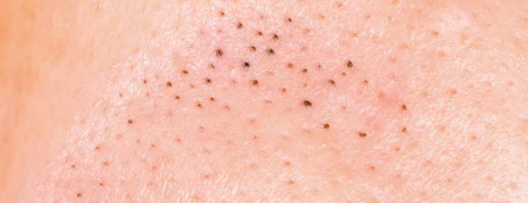 Blackheads on Inner Thighs - How to Get Rid of Them For Once and