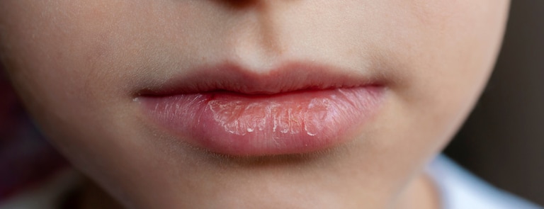 Chapped Lips: Causes & Remedies | Holland & Barrett