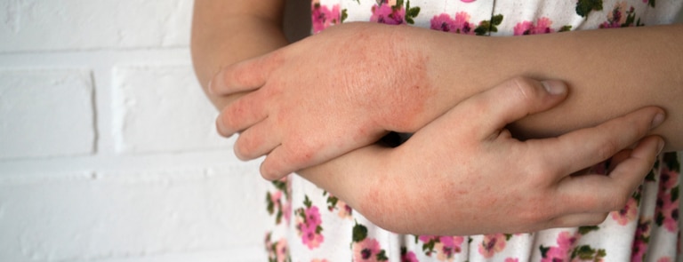 What Is Contact Dermatitis Causes Symptoms And Treatment Holland And Barrett