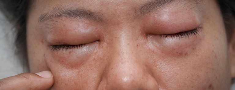 swollen face allergy