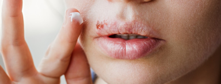 woman applying cream to cold sore on lip