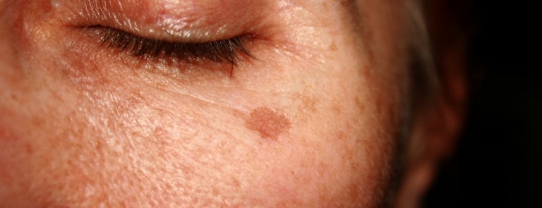 age spots on face