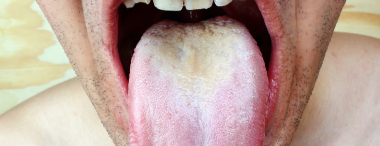 mouth infection