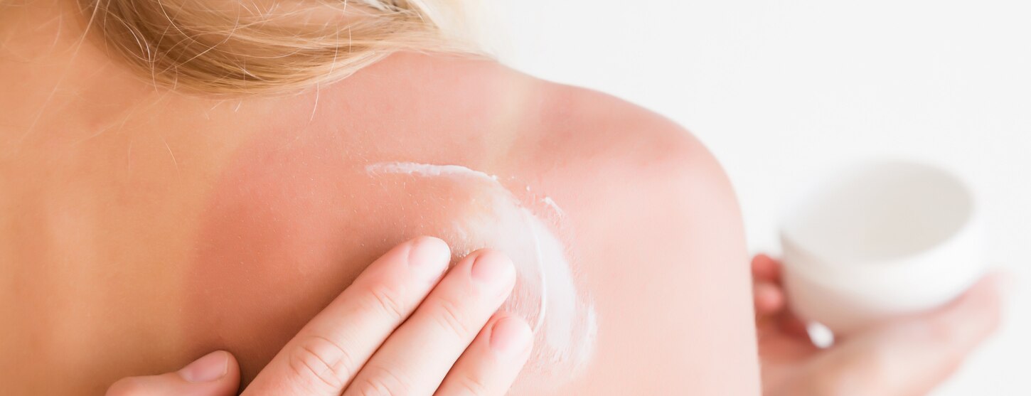 Are You Using Appropriate After Sun Care? image
