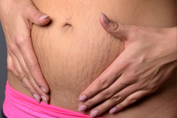 stretch marks example