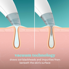 Image 3 for Homedics Refresh Hydradermabrasion
