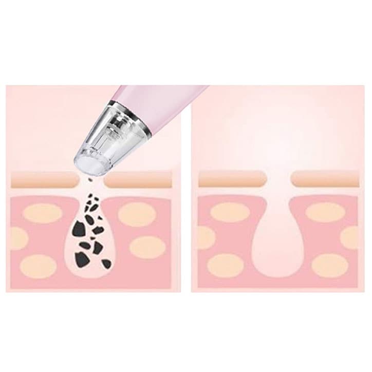 Magnitone PorePatrol Skin Renewing Pore Extraction System (Pink)