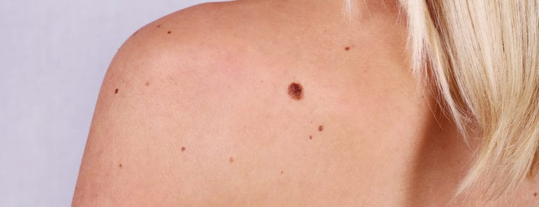 A women's shoulder with beauty spots and moles on it
