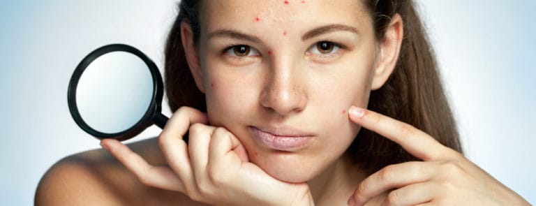 Myths and facts about acne image