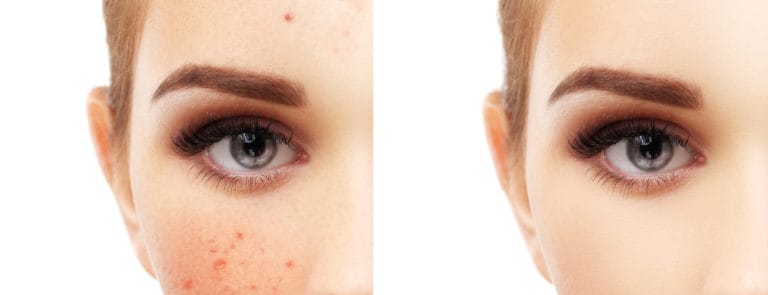 Women clear face and spotty face