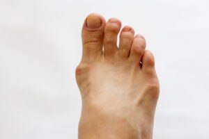 gout on foot 