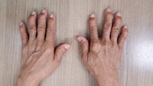 gout on hands and fingers