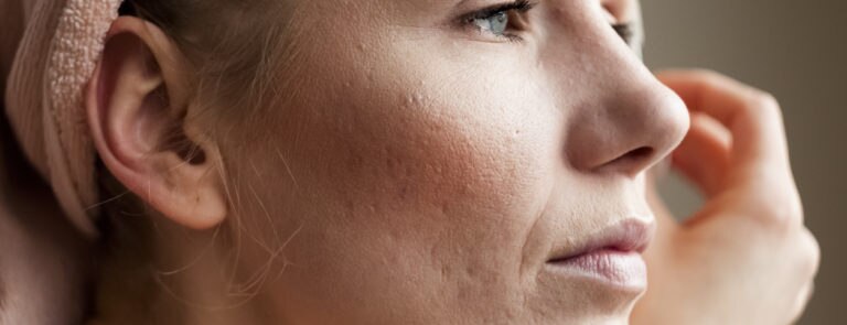 Acne scarring: Q&A image