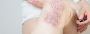 What is psoriasis Q&A?
