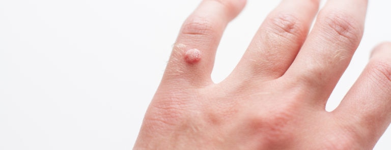 How to deal with warts on hands and fingers image