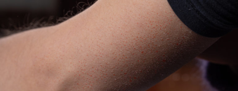 What is keratosis pilaris and do I need a keratosis pilaris cream? We discuss keratosis pilaris causes and how to minimise symptoms.