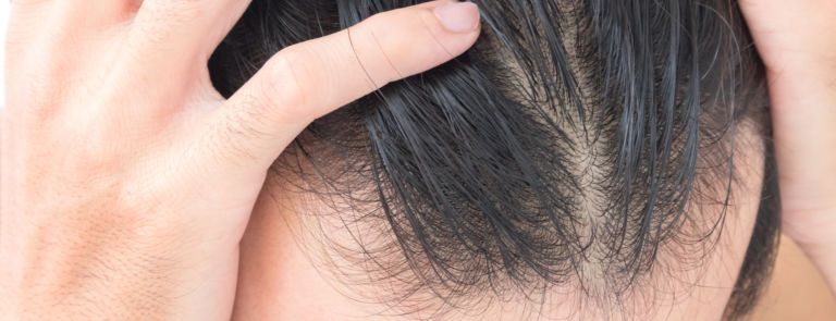 How to prevent thinning hair image