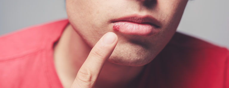 9 Home Remedies For Cold Sores image