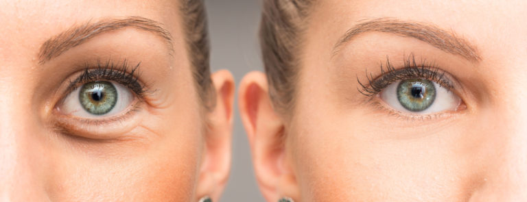 how to reduce the appearance of puffy eyes