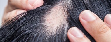 Alopecia Areata: What Is Is?