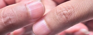 What Causes Ridged Nails & Treatements